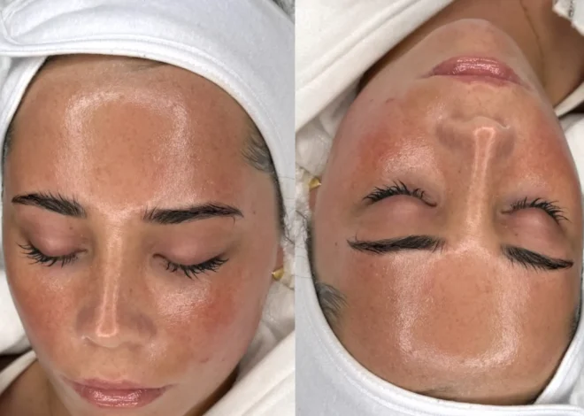 Can I Do Dermaplaning Myself?