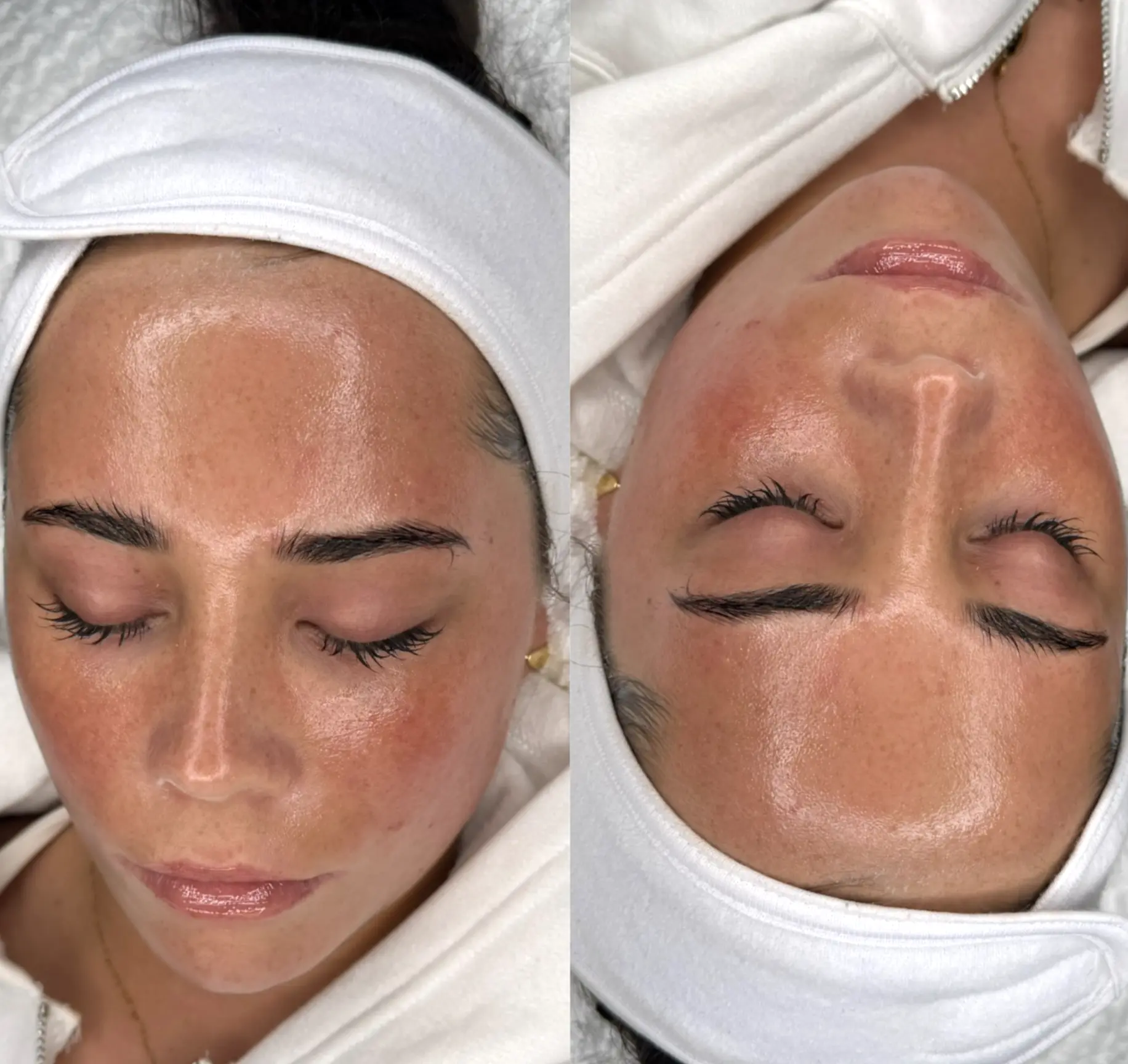 Can I Do Dermaplaning Myself?