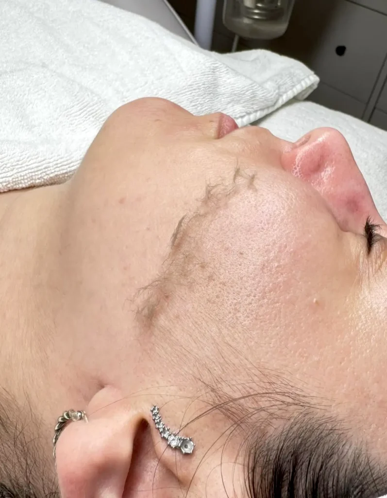 Safe Dermaplaning Starts with Skin Prep