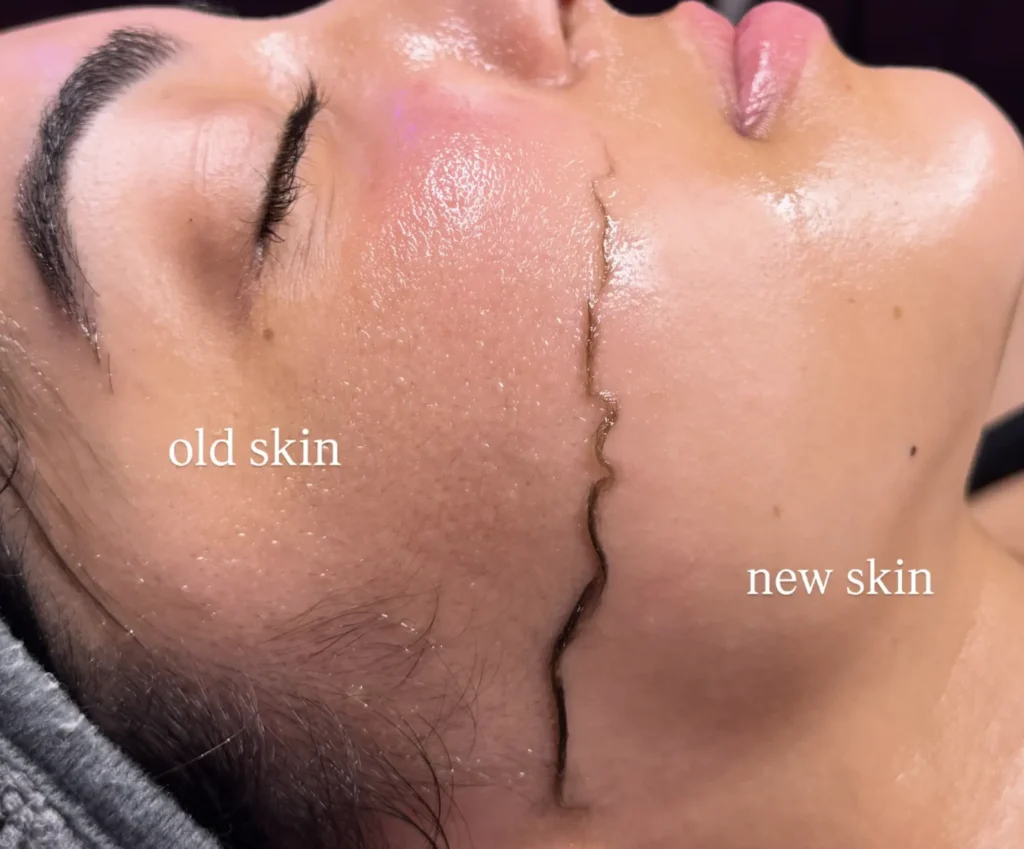 What Is Dermaplaning