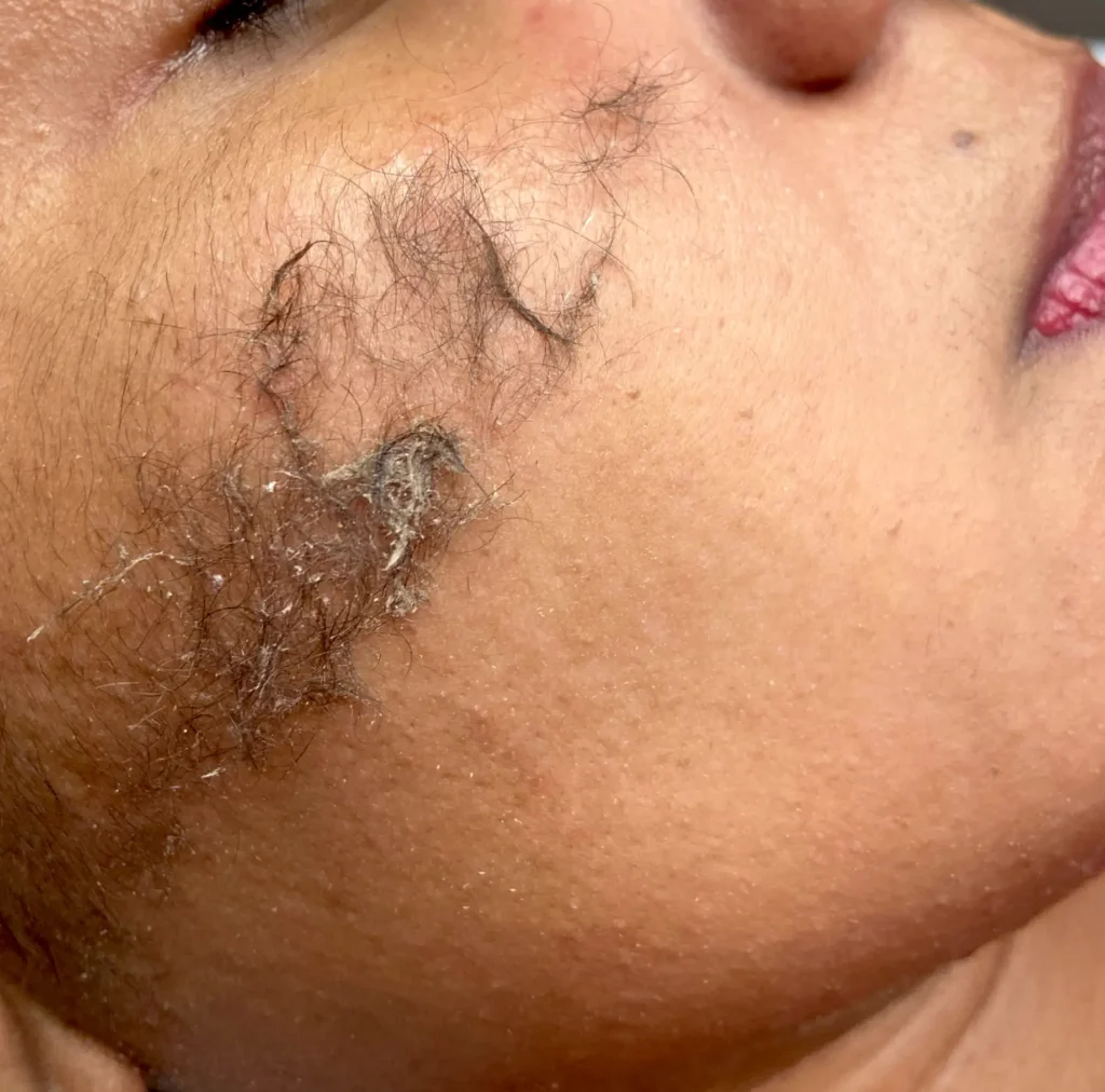 Who Shouldn’t Dermaplane at Home