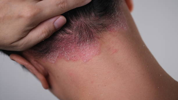 Ultimate Scalp Care: Treating Seborrheic Dermatitis Effectively