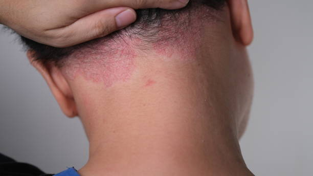 Close-up of a person with a visible skin condition on the back of the head and neck