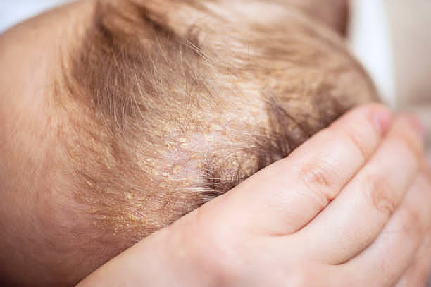 Close-up view of cradle cap on infant scalp with visible flakes and mother's hand