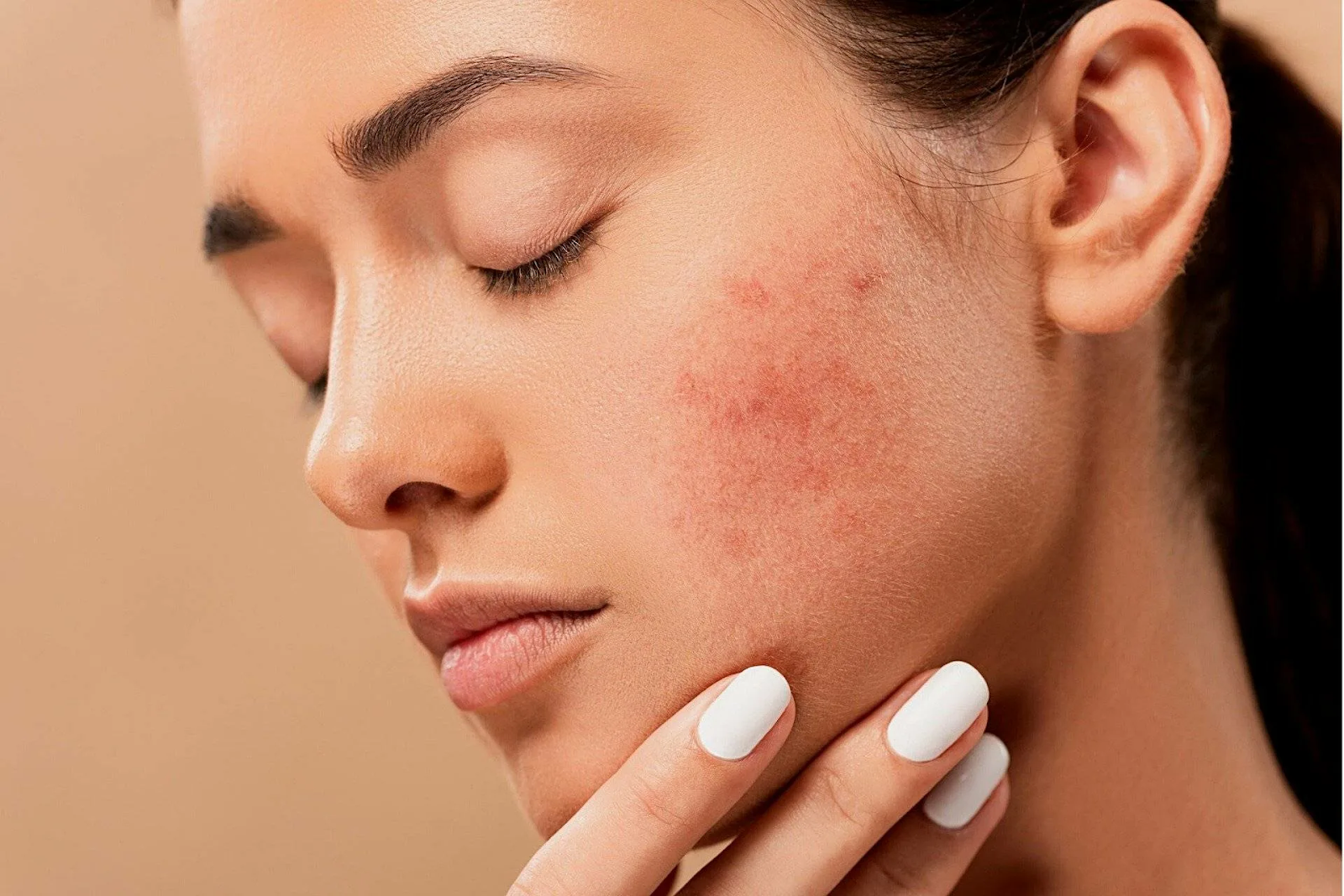 Find out the timeline for a blind pimple to heal and recommended treatments for quick relief.